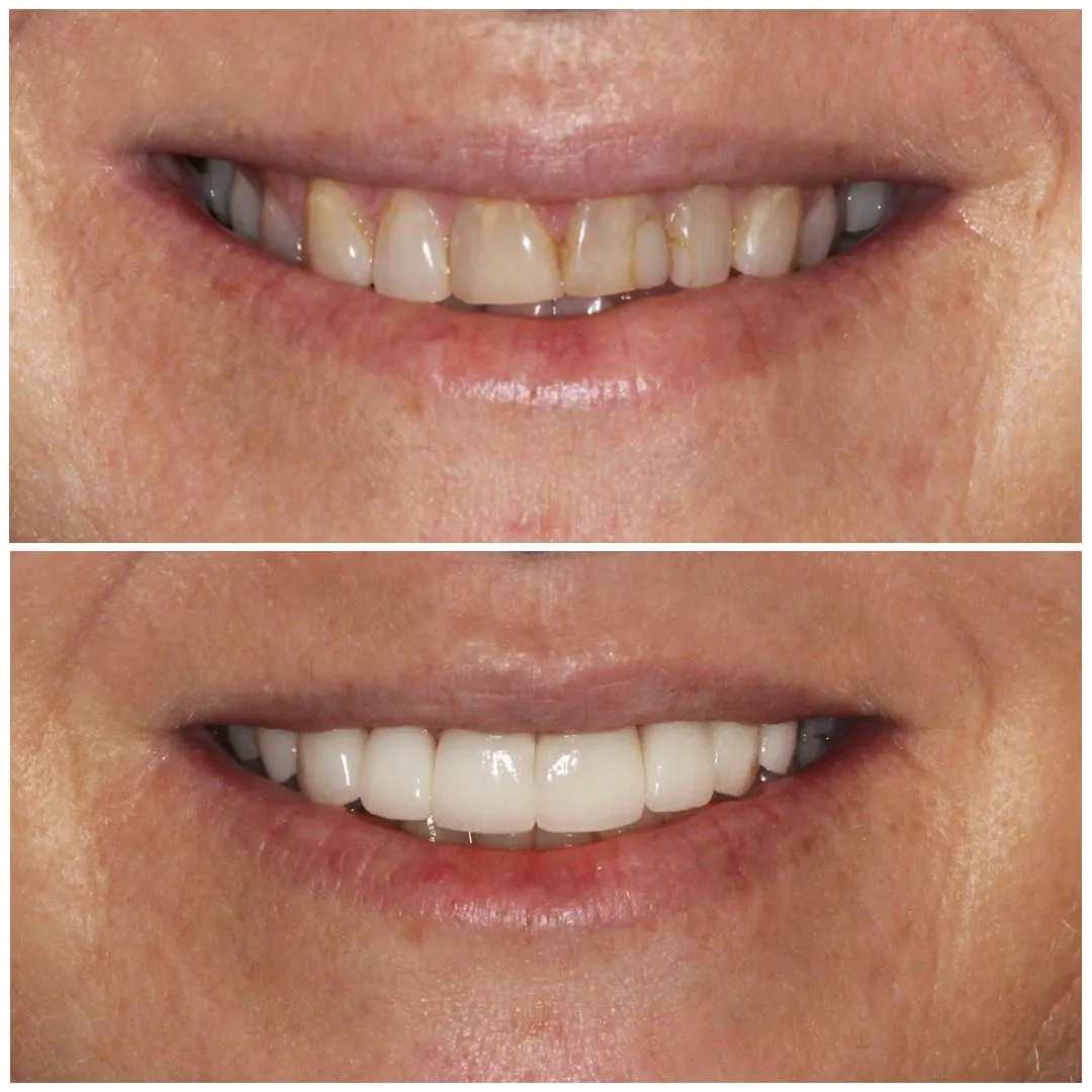 Veneers dentist in Indianapolis reviewing porcelain veneer shades with a patient at Luxia Dental