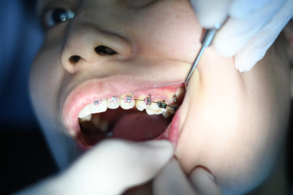 Tooth Extraction