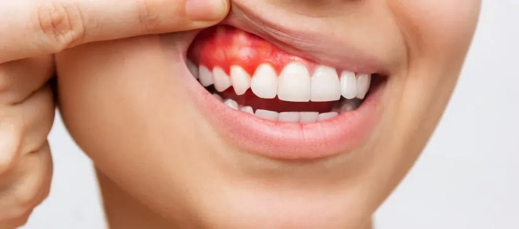 What Do Healthy Gums Look Like Compared to Unhealthy Gums?