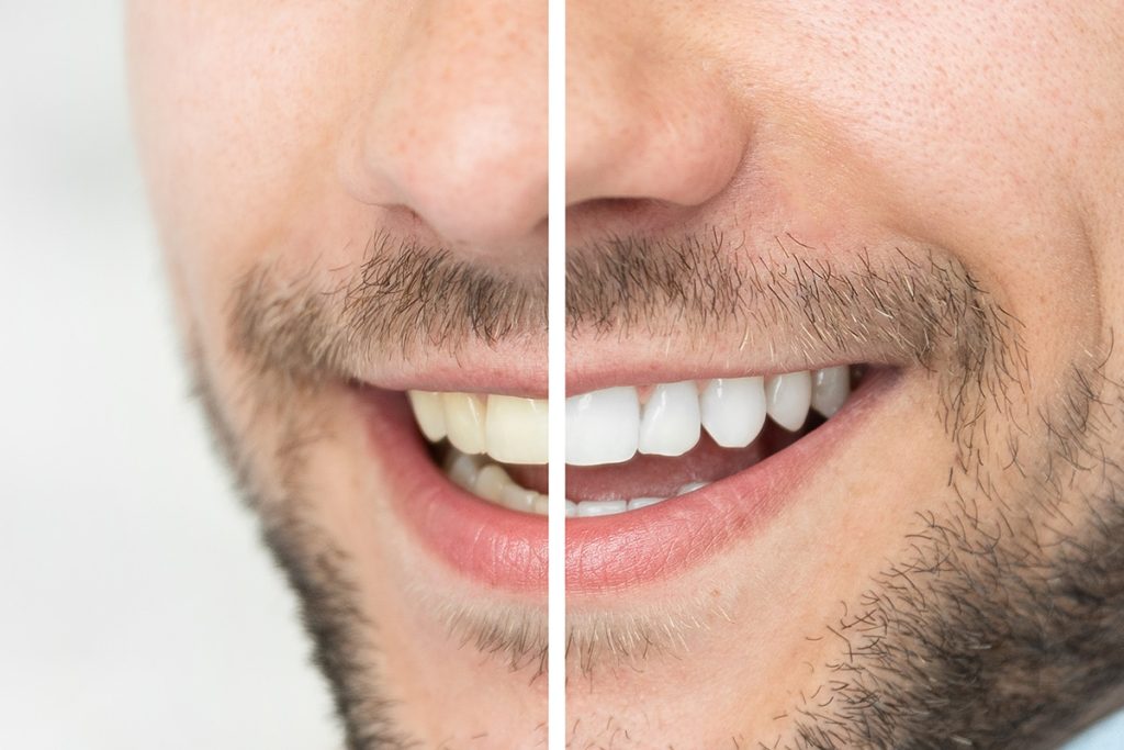 Teeth Whitening Cost at a Dentist in the USA