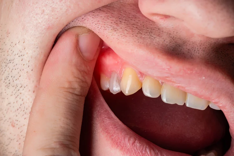 Main Causes of Painful Receding Gums in One Tooth