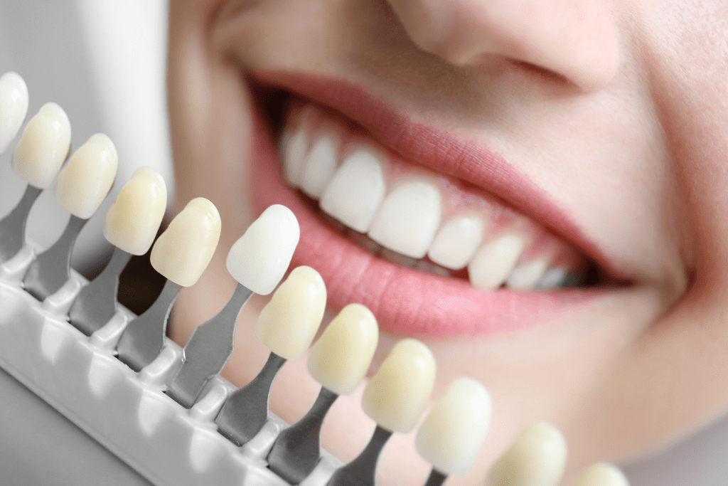 Teeth Whitening Cost at a Dentist in the USA?